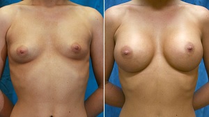 breast-enlargement